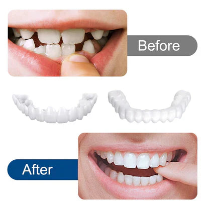 SnapOn Smile Dental Veneers – قشرة ابتسامة سناب أون